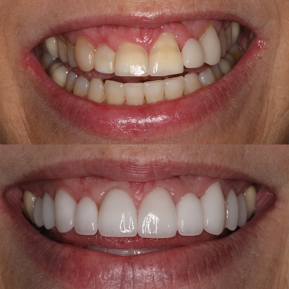 michelle-before-after