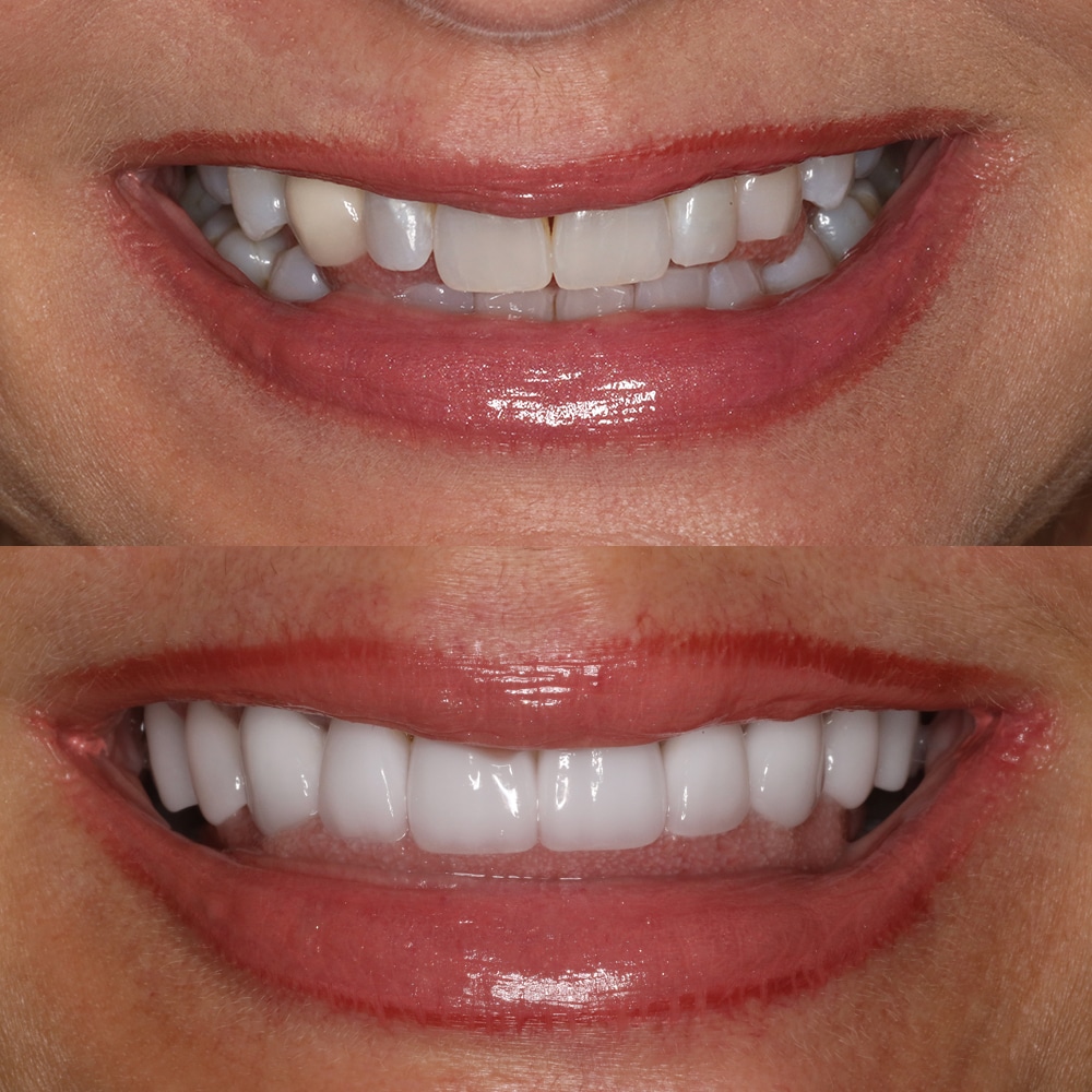 shannon-before-after