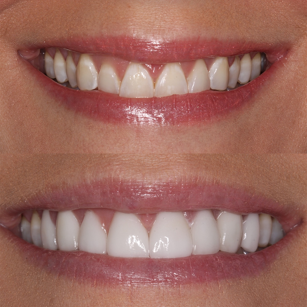 unknown-before-after