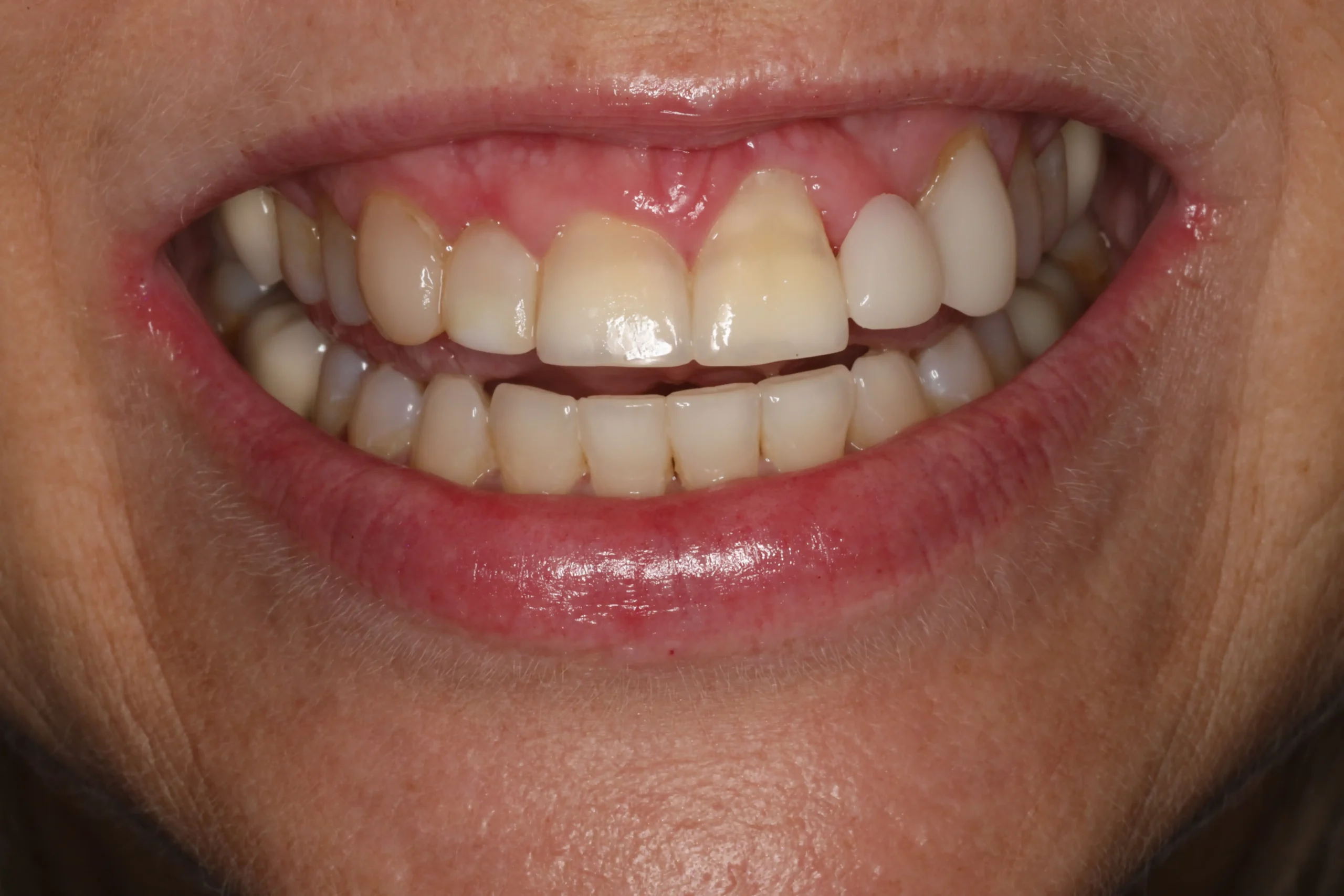 Michelle Before3 scaled