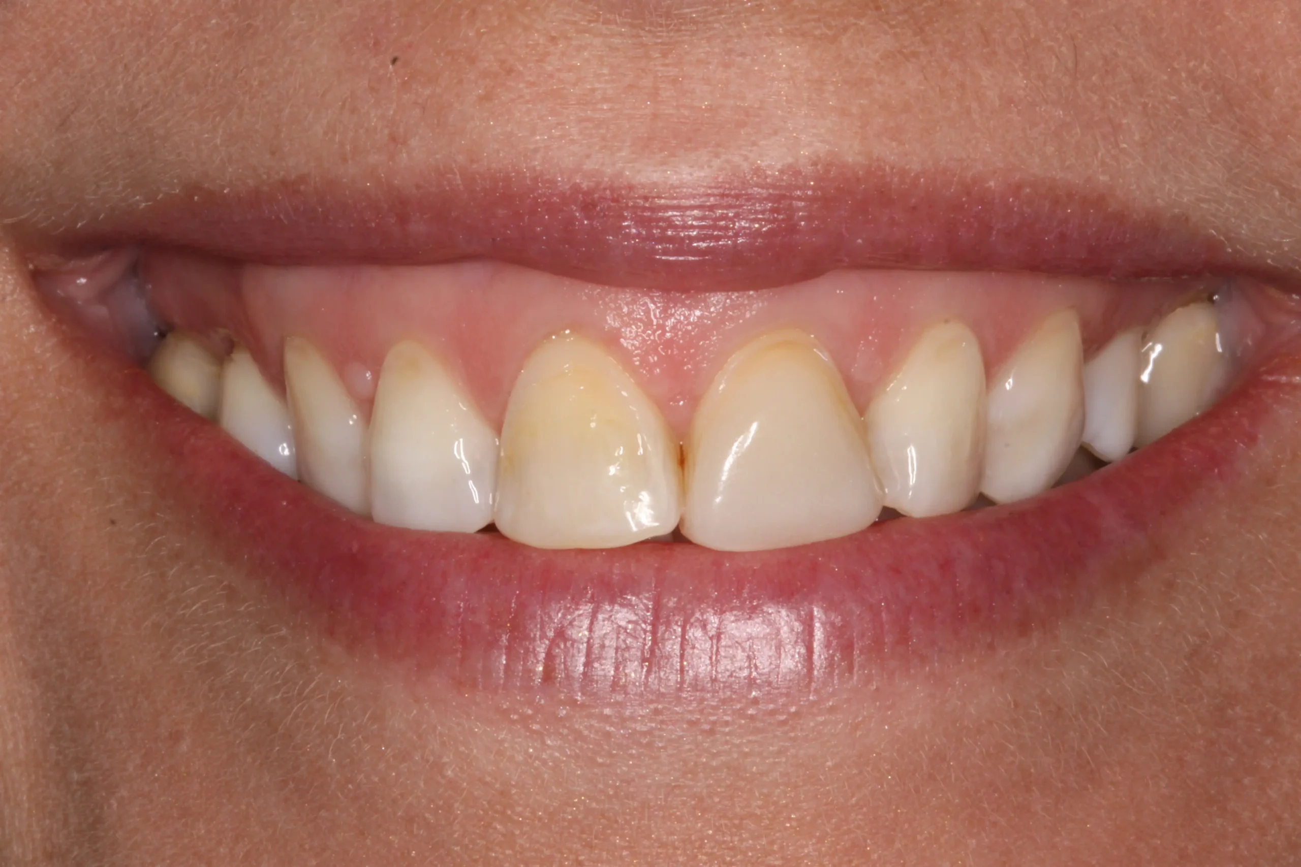 Nicky Befores3 scaled