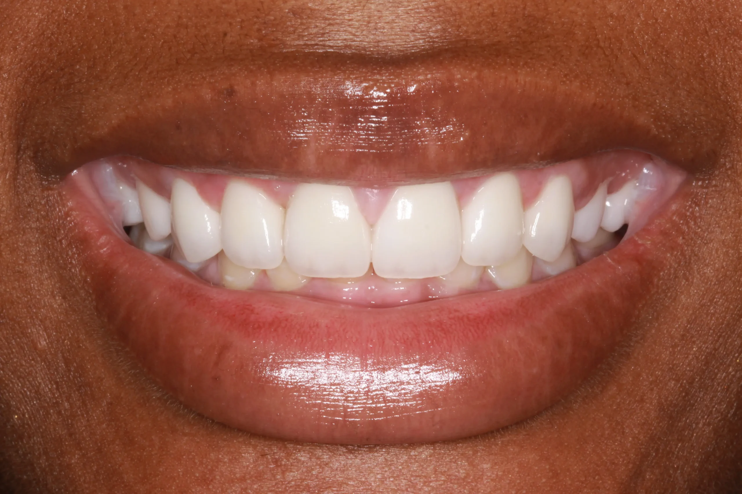 Raven Gum Lift and Veneers After 1 scaled
