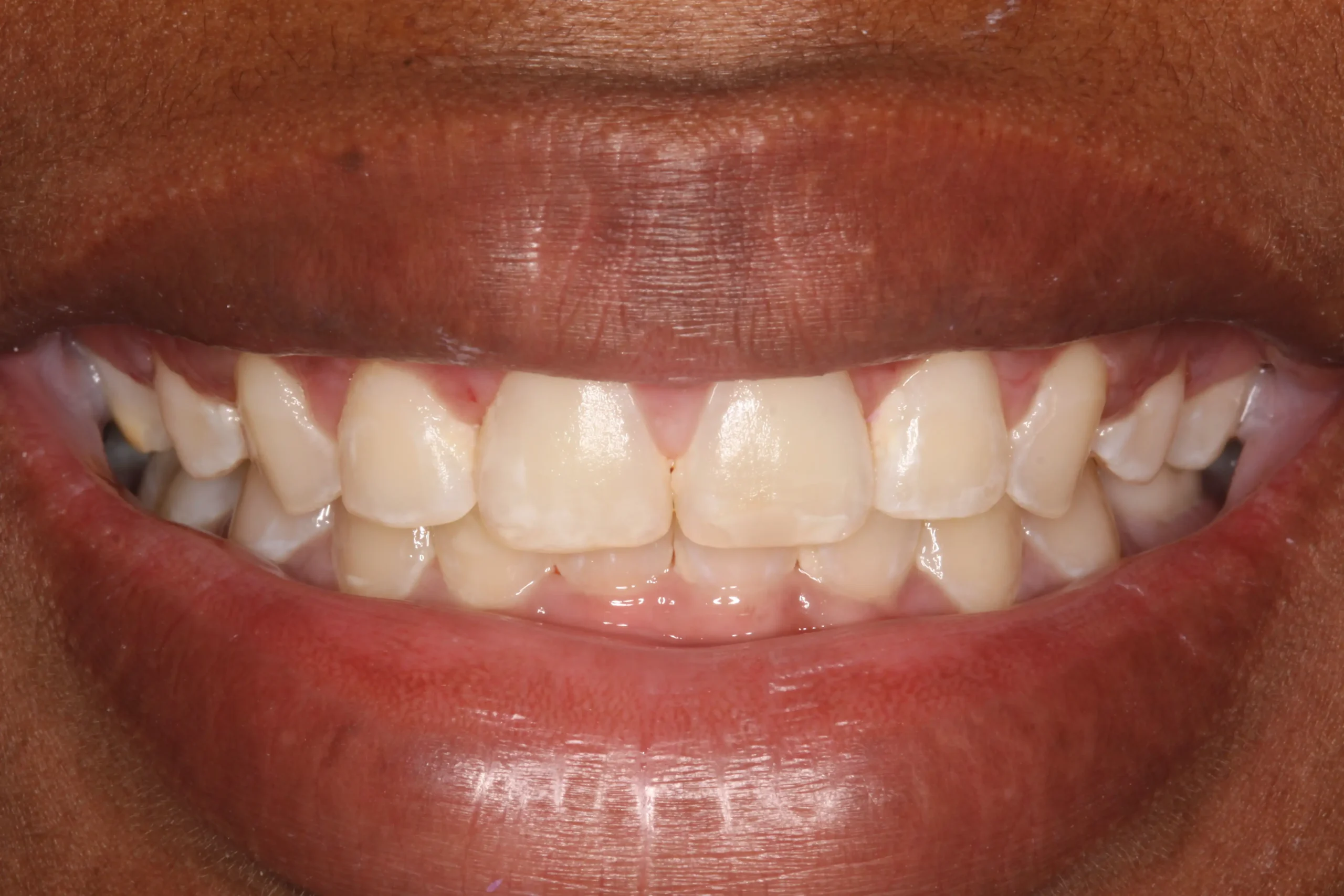 Raven Gum Lift and Veneers Before1 scaled