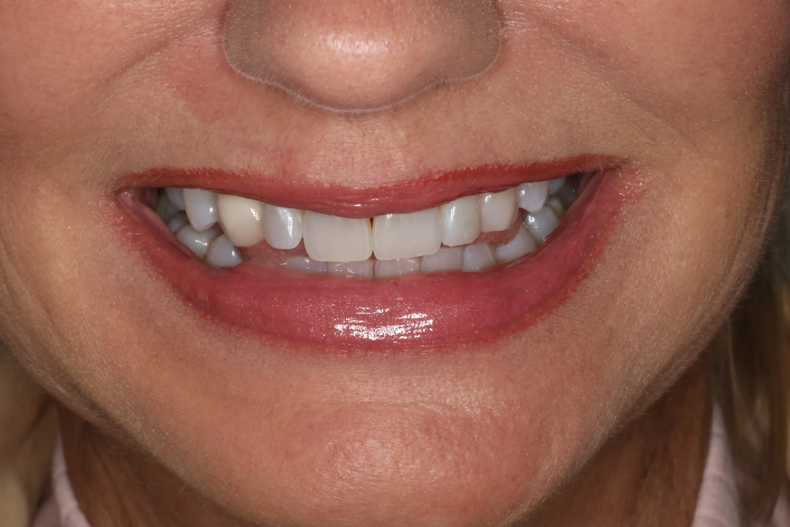 Shannon Before3 scaled