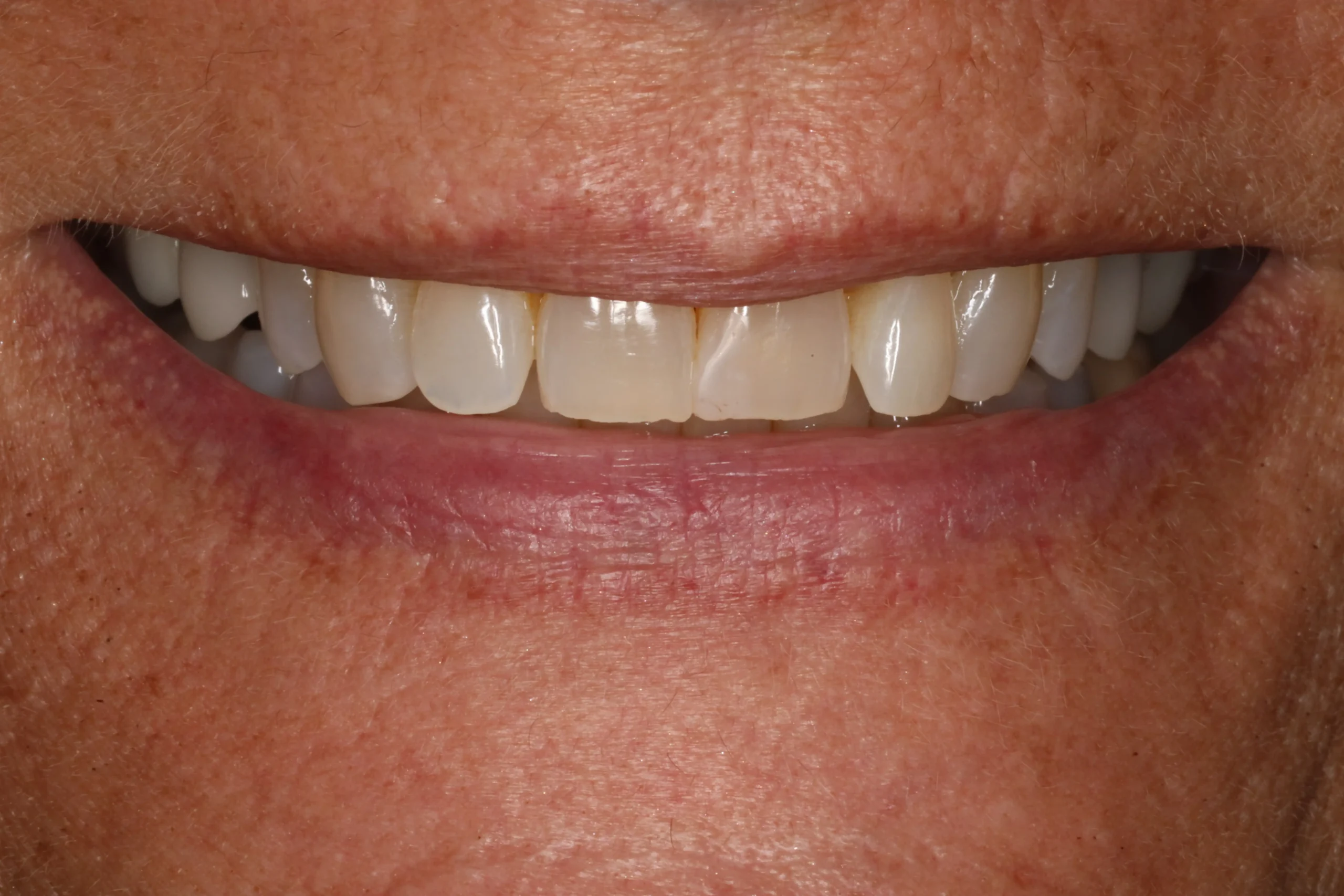 Tatia Befores1 scaled